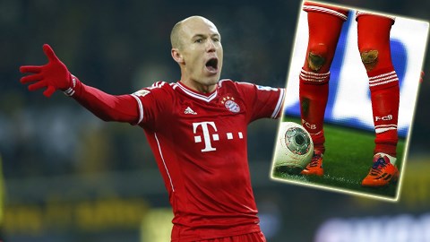 Robben bị “rách đầu gối” vì ăn mừng bàn thắng