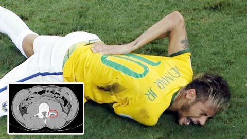 Cận cảnh bức ảnh chấn thương lưng suýt khiến Neymar giải nghệ