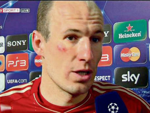 Gương mặt có vết xước của Robben khi trả lời phỏng vấn sau trận đấu với Real