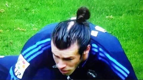 Bale nhập hội cấy tóc chống hói