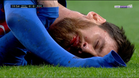 Trận thứ 2 liên tiếp Messi đổ máu trên sân