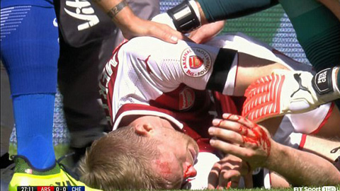 Đội trưởng của Arsenal phải rời sân do mất nhiều máu