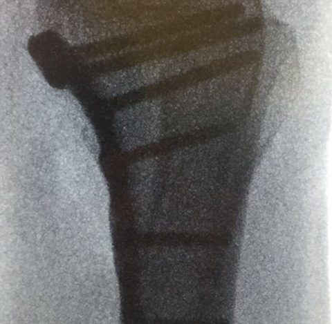 Hình chụp X-quang của Shearer sau phẫu thuật