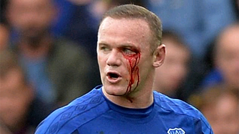 Ăn cùi chỏ của đối thủ, Rooney chảy máu mắt đầm đìa