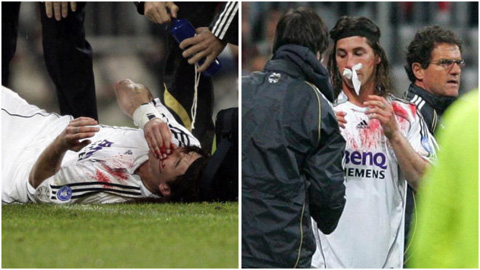 Ramos từng thi đấu 3 tháng với cái mũi vỡ