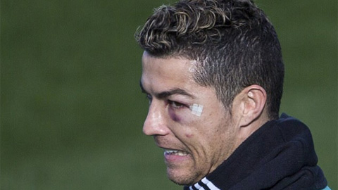 Ronaldo ra sân tập với một bên mắt sưng húp