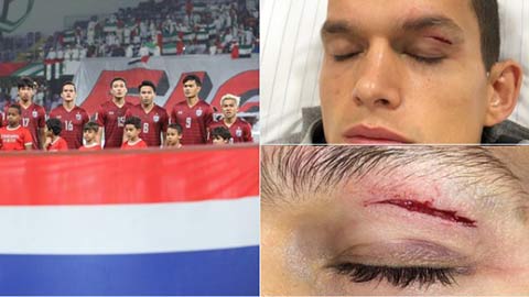 Hậu vệ Thái Lan rách mí mắt sau pha va chạm với cầu thủ UAE