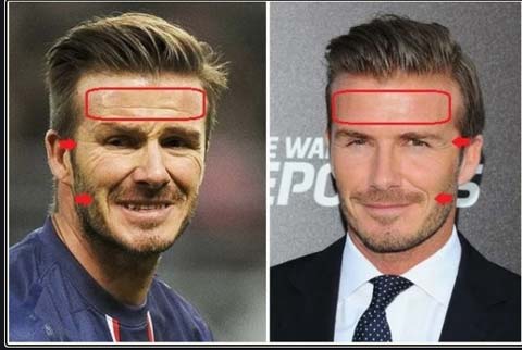 Beckham bị nghi “độ trán”