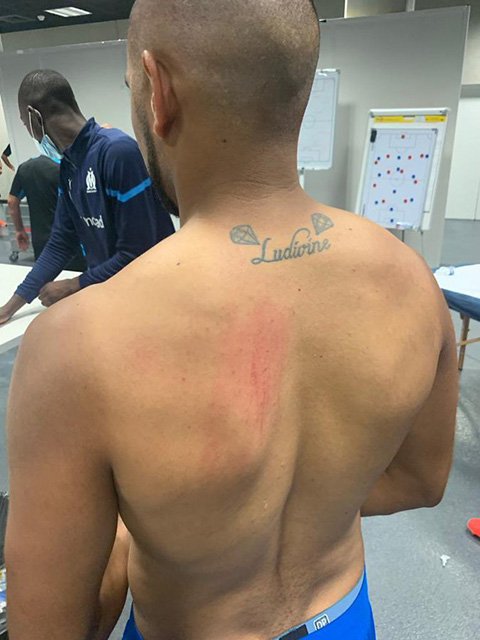 Vết thương trên lưng Payet và của các thành viên Marseille khác