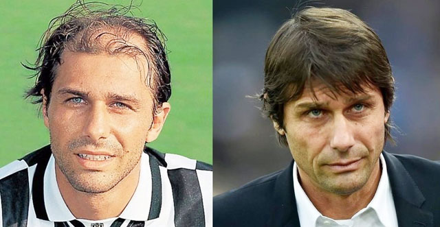 Antonio Conte cũng tìm lại phong độ nhờ cấy tóc