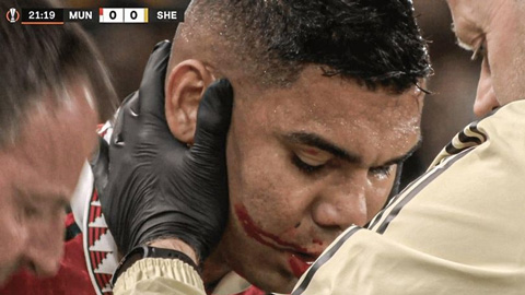 Casemiro chảy bê bết máu sau khi ăn cùi chỏ của cầu thủ Sheriff