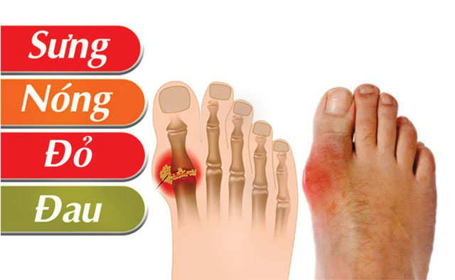Người bị bệnh gout thường bị sưng, nóng, tấy đỏ và đau các khớp xương