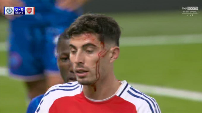 Máu lại chảy trên khuôn mặt Havertz