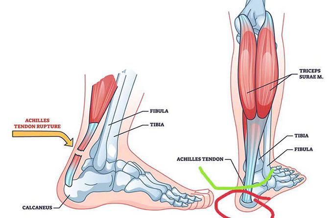 Khu vực khoanh đỏ là vị trí mà cầu thủ nên nghỉ, tránh việc tổn thương kéo dài sau này. Khu vực xanh trở lên ở mức độ nhẹ, sớm bình phục 