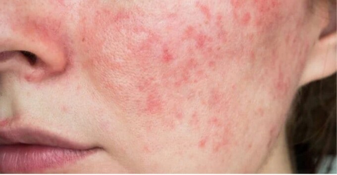 Da nhiễm corticoid ngày càng phổ biến trong cộng đồng (Ảnh minh họa)