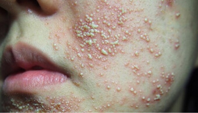 Da bị nhiễm corticoid nặng.