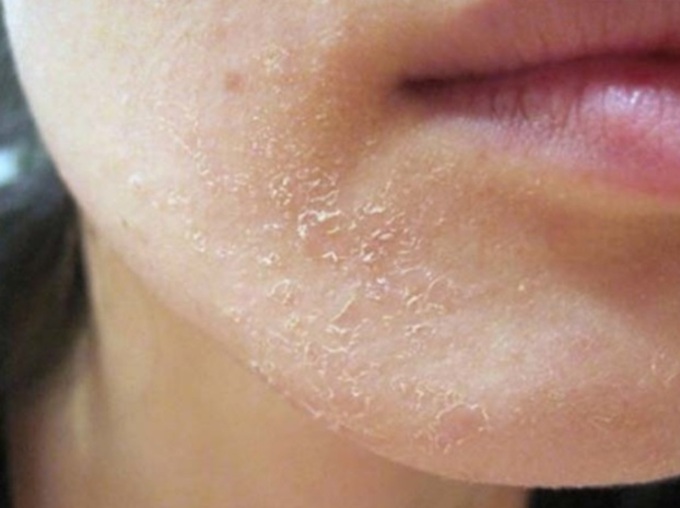 Thời tiết hanh khô là điều kiện thuận lợi cho vảy nến xuất hiện.