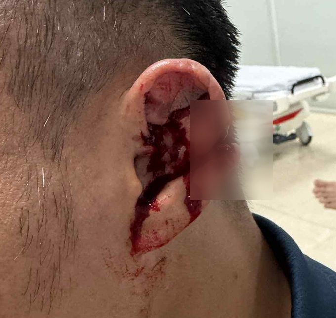 Trọng Hoàng đi khâu tai sau trận đấu - Ảnh: Bóng đá & Đời sống 