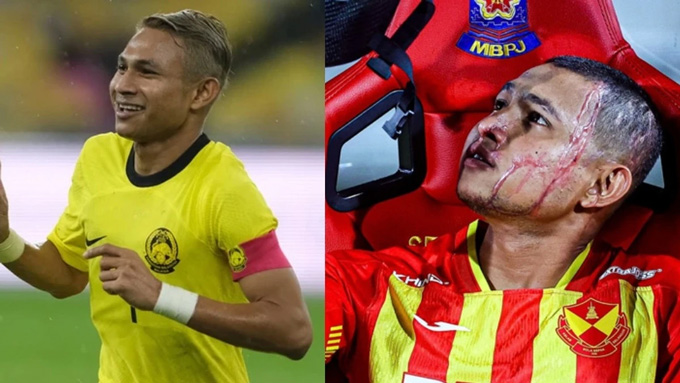 Khuôn mặt Faisal Halim biến dạng sau vụ anh bị tạt axit