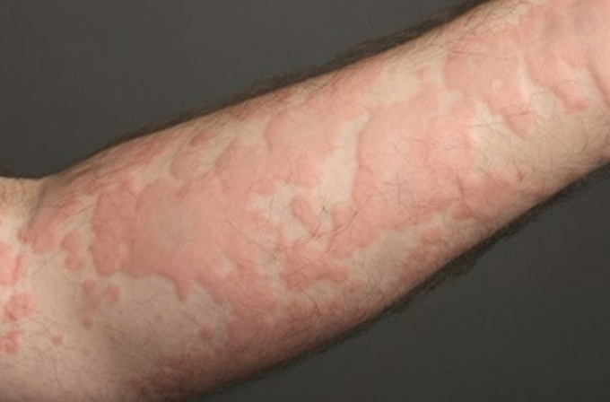 Da ở giai đoạn đào thải tương đối nhạy cảm nên cần chăm sóc tốt