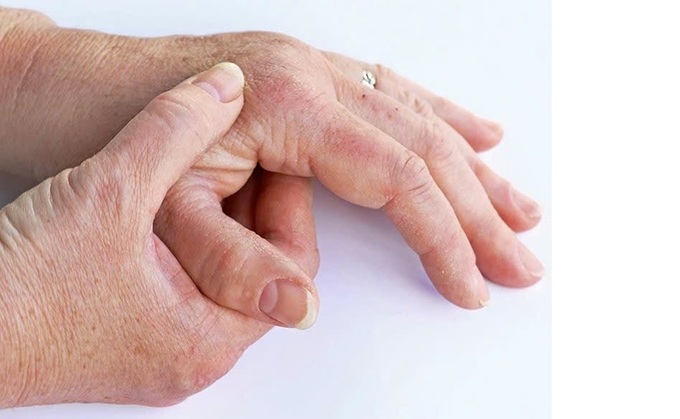 Vảy nến do phong nhiệt.