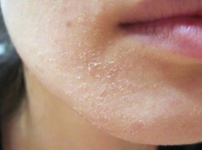 Thời tiết hanh khô là điều kiện thuận lợi cho vảy nến xuất hiện.