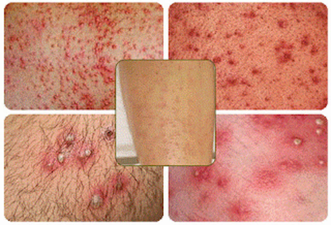 Viêm nang lông xuất hiện dưới nhiều dạng khác nhau.