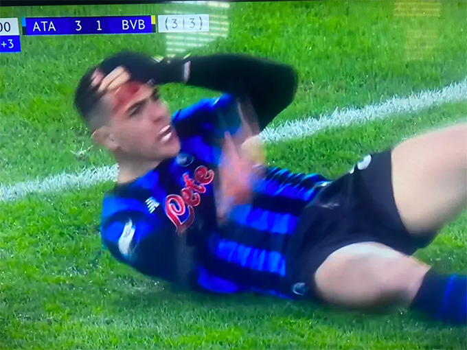 Sau cú va chạm mạnh, mặt của ngôi sao Atalanta chảy đầy máu và cần phải điều trị