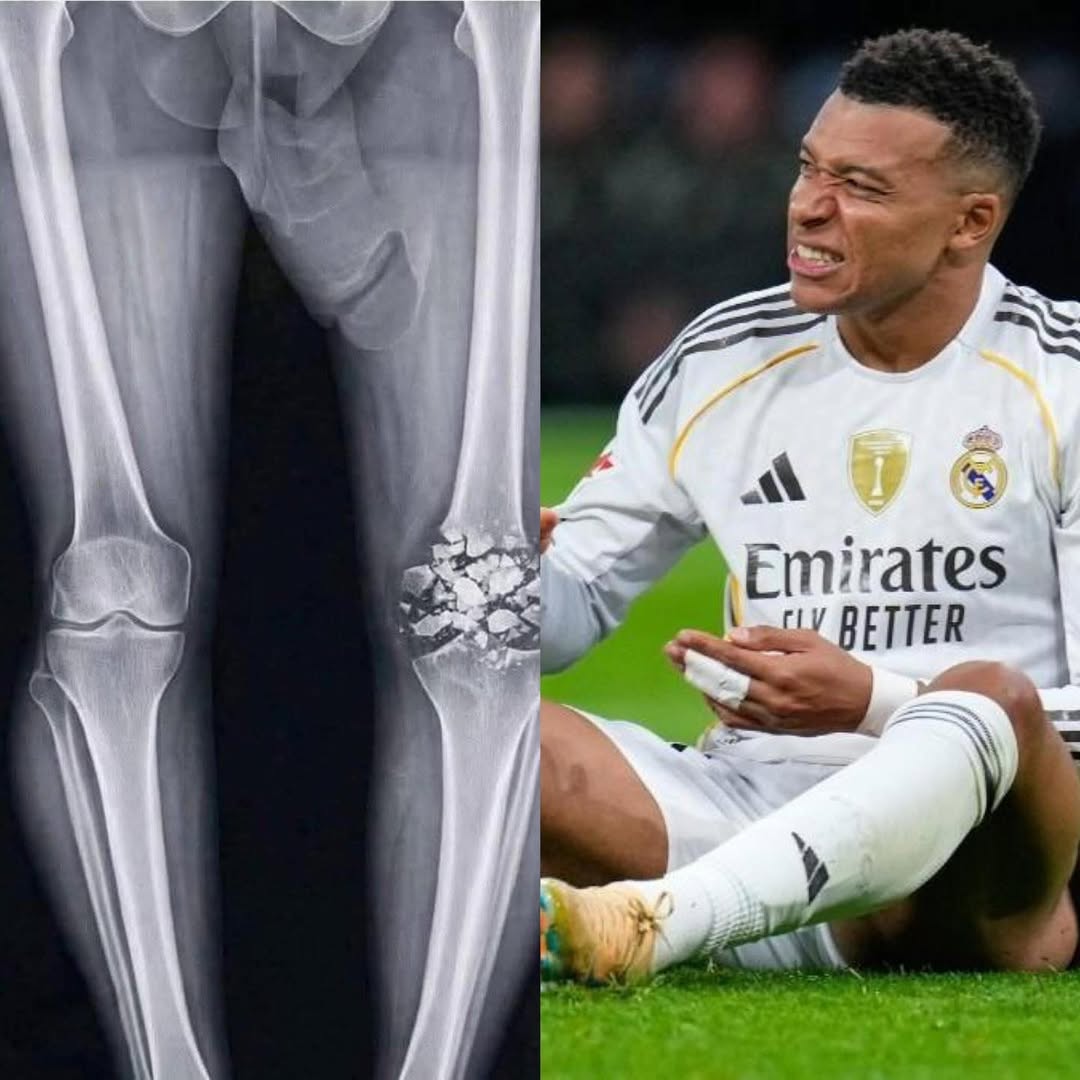Sau khi nói bị bác sĩ ở CLB chụp phim nhầm chân, Mbappe đã phủ nhận điều đó