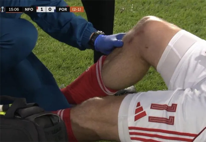 Những vết thương trên chân anh có thể được nhìn thấy trên camera truyền hình. Ảnh: TNT Sports