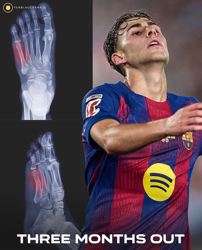 Fermin Lopez đã bị gãy xương bàn chân số 5 bên phải - Ảnh: @forblaugrana
