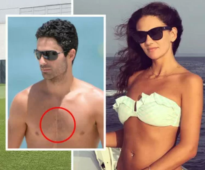 Mikel Arteta từng phải phẫu thuật tim khi còn nhỏ