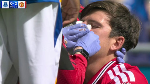 Maguire bị chảy khá nhiều máu nhưng vẫn có thể tiếp tục thi đấu - Ảnh: Sky Sports