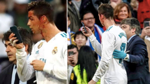 Ronaldo lấy Iphone soi nhan sắc ngay trên sân khi bị chảy máu mặt