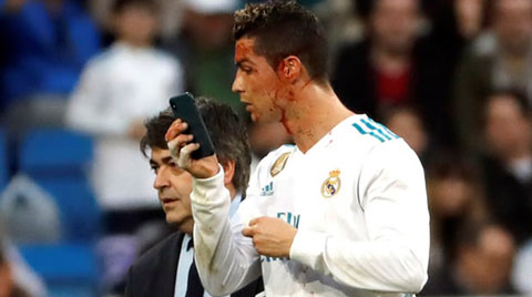 Mẹ và bạn gái đau xót khi Ronaldo bị chảy máu mặt