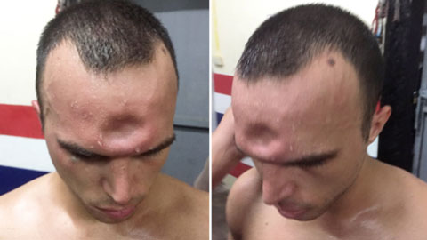 Võ sỹ Muay Thái suýt vỡ sọ vì cú đấm của đối thủ