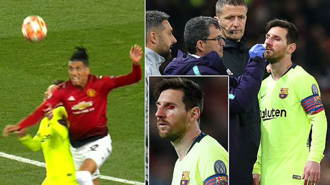 Messi chảy máu đầm đìa sau khi bị trung vệ M.U gạt tay trúng mặt