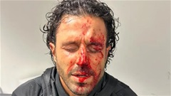HLV Fabio Grosso của Lyon chảy máu đầm đìa vì bị CĐV ném đá