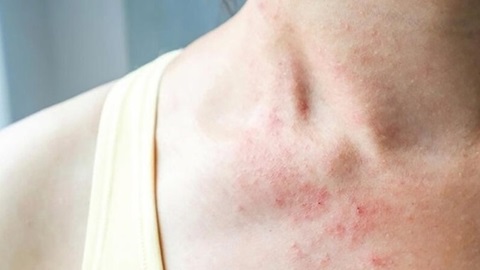 Bảo Thanh Đường - Địa chỉ uy tín chữa tận gốc bệnh chàm (eczema)