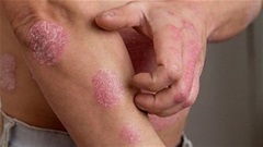 Bổ huyết - Dưỡng âm: Nguyên tắc trong điều trị bệnh viêm da lâu ngày
