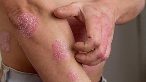 Bổ huyết - Dưỡng âm: Nguyên tắc trong điều trị bệnh viêm da lâu ngày