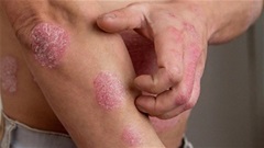 Bổ huyết - Dưỡng âm: Nguyên tắc trong điều trị bệnh viêm da lâu ngày
