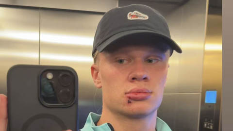 Erling Haaland  'đổ lỗi' cho thủ quân của Arsenal vì bị rách mồm