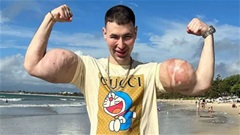 'Quái vật phòng gym' trả giá đắt vì bơm hoá chất vào 2 bắp tay