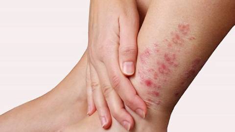 Bảo Thanh Đường - Địa chỉ uy tín chữa tận gốc bệnh chàm (eczema)