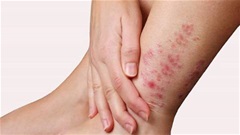 Bảo Thanh Đường - Địa chỉ uy tín chữa tận gốc bệnh chàm (eczema)