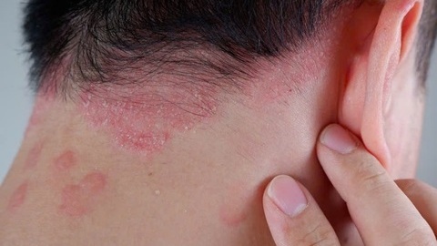 Vảy nến tái phát - Cách điều trị từ lời khuyên các chuyên gia Bảo Thanh Đường
