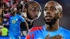 Người hùng giúp CHDC Congo cầm hòa Bồ Đào Nha suýt mù vì bị tạt axit