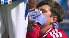 Maguire đổ máu sau pha va chạm kinh hoàng đầu trận Everton vs MU