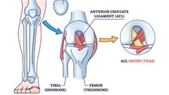 Chấn thương ACL, nỗi ám ảnh của cầu thủ bóng đá